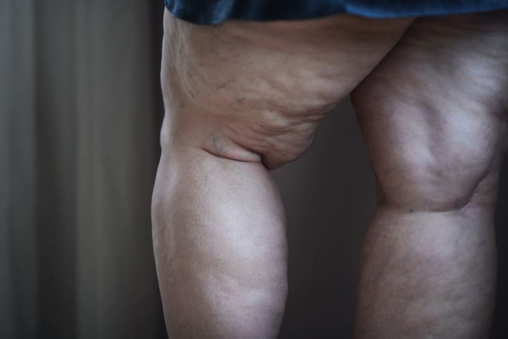 Mulher caucasiana com lipedema