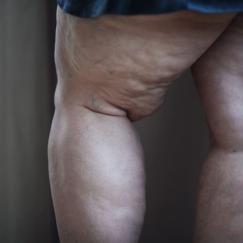 Mulher caucasiana com lipedema