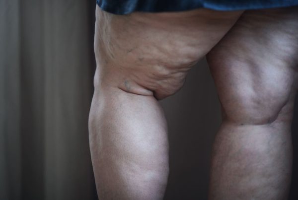 Mulher caucasiana com lipedema