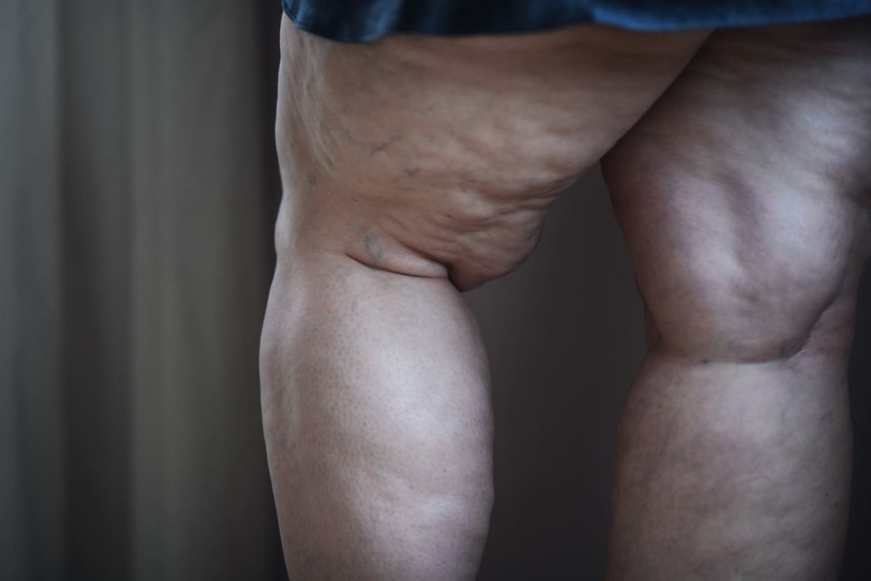 Lipedema: enquadramento clínico, diagnóstico e abordagem terapêutica